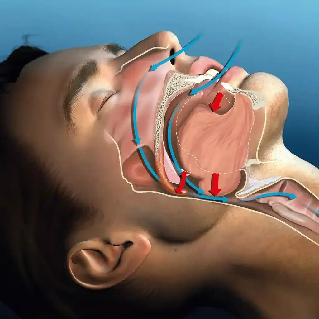 A SleepAir szájtapasz használata megakadályozza az éjszakai horkolást