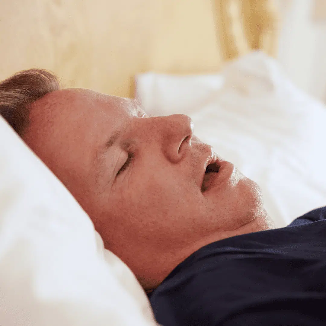 Középkorú férfi nyitott szájjal alszik egy fehér párnán – a helytelen szájlégzés alvás közben.