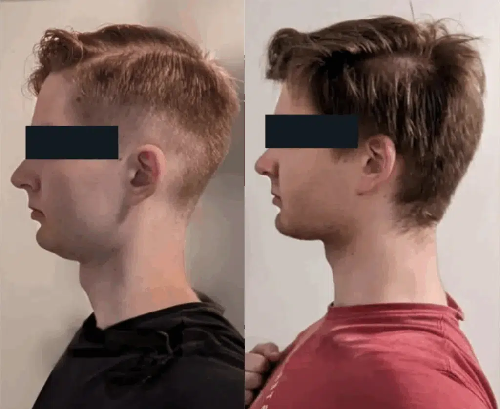 Két oldalnézeti fotó ugyanarról a fiatal férfiról. A bal oldali képen enyhén előrehelyezett fejjel látható, a nyaka hajlottabb, az állkapcsa kevésbé határozott. A jobb oldali képen a testtartása egyenesebb, a nyaka hosszabbnak és az állkapcsa markánsabbnak tűnik. A kép a szájlégzés hosszú távú hatásait illusztrálja az arcesztétikára és testtartásra.